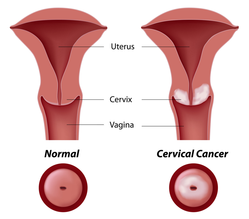 Abnormal Pap Smear International Women S Clinic