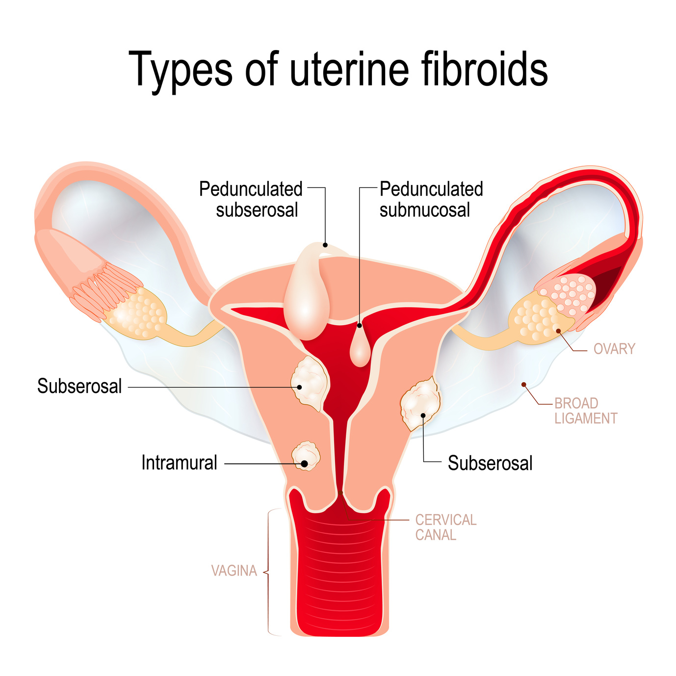 Uterine Fibroids - International Women's Clinic