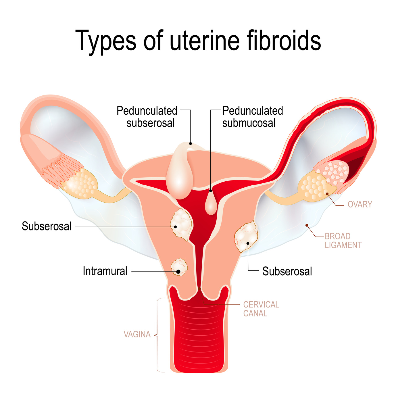 how-to-get-rid-of-uterine-fibroids-without-surgery