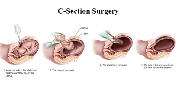 C Section Procedure