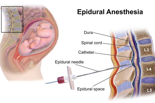 Epidural and Spinal Anaestthesia
