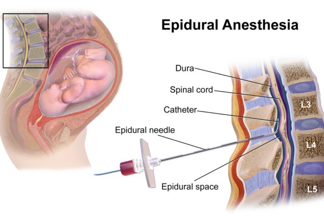 Epidural and Spinal Anaestthesia