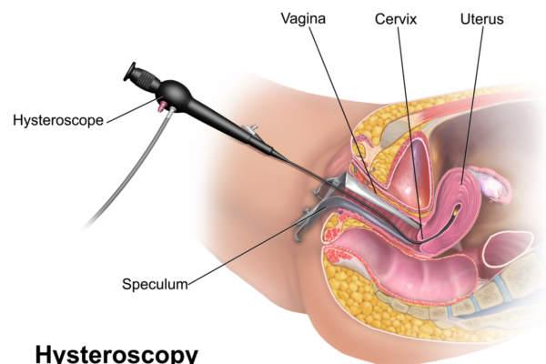 Diagnostic and Operative Hysteroscopy