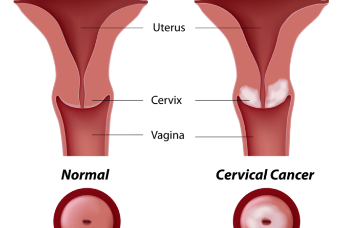 Abnormal Pap Smear - International Women's Clinic