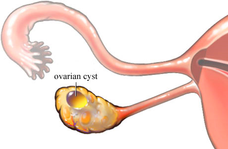 An ovarian cyst is a fluid-filled sac that forms on or within an ovary.  Ovarian cysts are quite common and often form during the menstrua