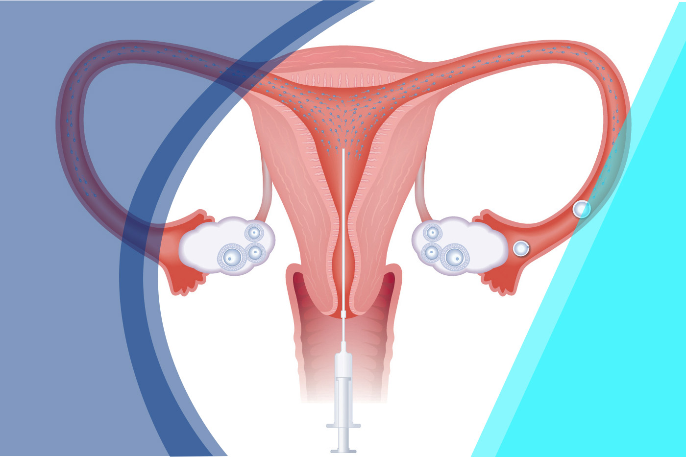 Ovulation Induction Intrauterine Insemination Ivf International