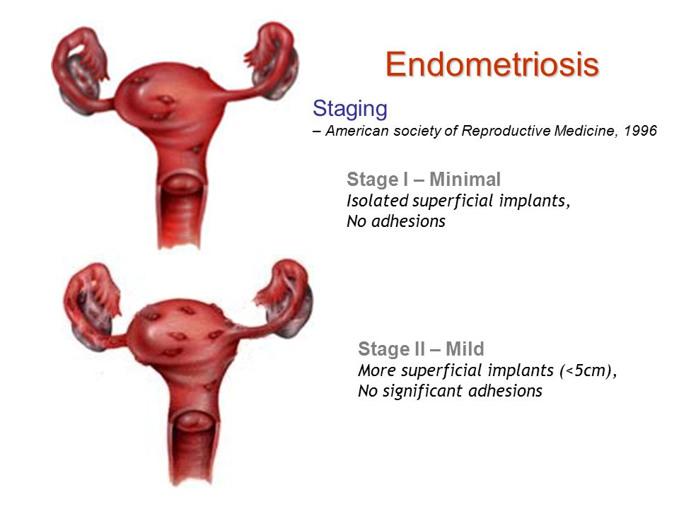 Endometriosis International Womens Clinic 9382