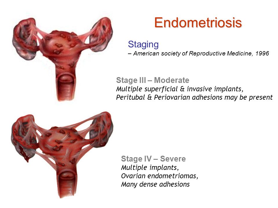 Endometriosis operación